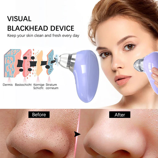 Purple 1080P HD Blackhead Remover Vacuum